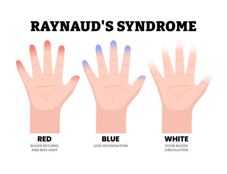 Raynaud&rsquo;s Syndrome Hand Disorder Symptoms Medical Illustration. Showing color changes of fingers due to poor blood circulation. Dermatology. Vascular disorder with red, blue white color hand.