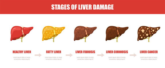 Liver disease. Stage of liver damage. Medical illustration of human anatomy. Treatment for cancer or hepatitis. Vector design.