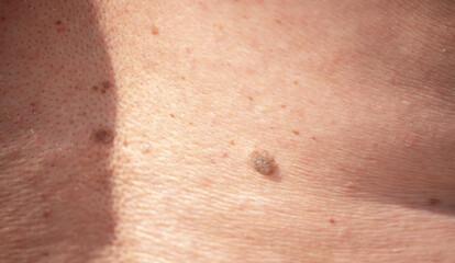 Fototapeta premium Nevus close-up. Mole on human skin. Irregular birthmark.