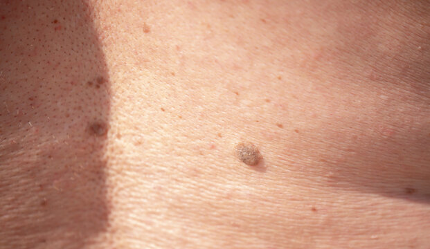 Nevus close-up. Mole on human skin. Irregular birthmark.