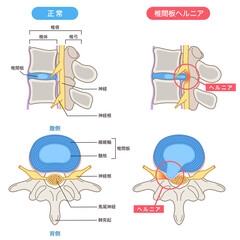 腰椎椎間板ヘルニア　椎間板の構造　腰痛