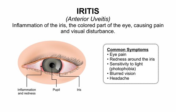 Iritis (Anterior Uveitis) Medical Infographic Flashcard