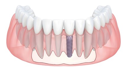 Fototapeta premium Digital Illustration of Dental Implant in Lower Jaw – 3D Rendering of Tooth Replacement Embedded in Bone