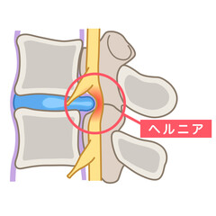 腰椎椎間板ヘルニア　椎間板の構造　腰痛