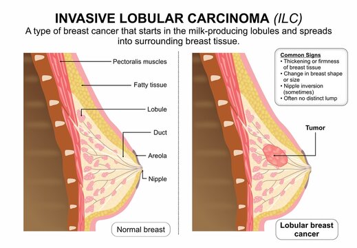 Invasive Lobular Carcinoma (ILC) Breast Cancer