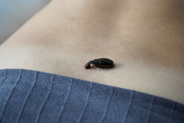 Medical leech attached to human skin during hirudotherapy treatment, close-up alternative medicine and healthcare concept.