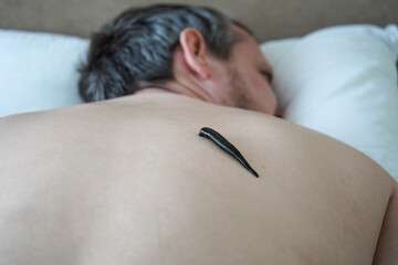Medical leech placed on human back during hirudotherapy session, alternative medicine and natural healing concept.