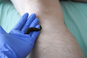 Medical leech therapy performed by healthcare professional wearing gloves, close-up of hirudotherapy treatment on patient leg.