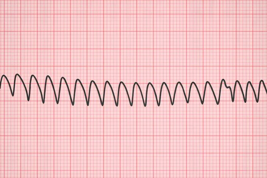 High-quality ECG rhythm strip showing ventricular tachycardia on graph paper, representing cardiac arrhythmia, emergency cardiology, heart rhythm disorders, and critical care monitoring.