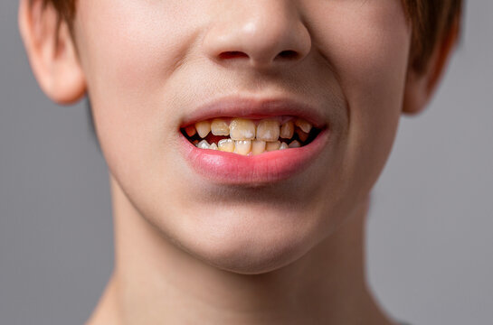 Mouth of a man with crooked yellow teeth. Yellow teeth of a woman before treatment and whitening of teeth, dental crowns. Dentistry closeup. Bad teeth child