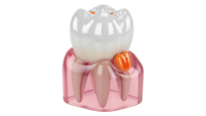 Isolated tooth gum model showing inflammation, dental anatomy illustration, educational tool
