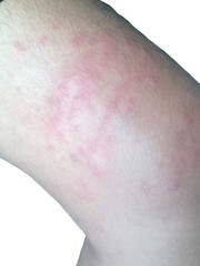 Naklejka premium Skin irritation on thigh from jellyfish sting with red rash and inflammation
