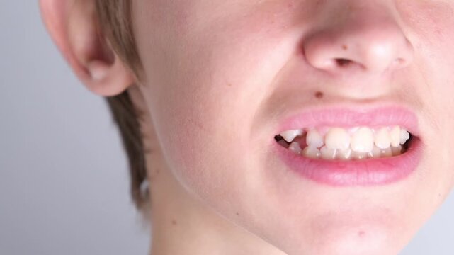 A teenage patient's teeth are shown with clear aligners. Clear aligner for teeth straightening.