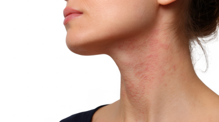 Close up of a woman's neck exhibiting a widespread red rash, indicating potential skin irritation or an allergic reaction, isolated on a transparent background