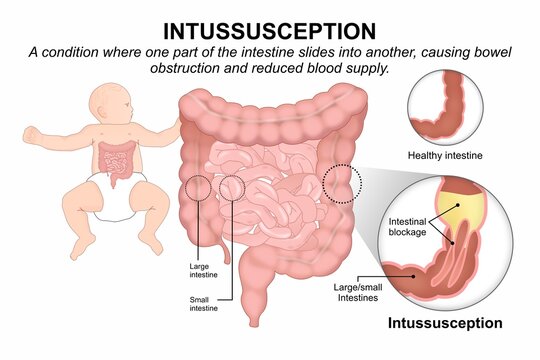 Intussusception Pediatric Gastrointestinal Emergency Infographic Flashcard