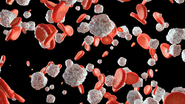 Chronic myelogenous leukemia (CML) In Bloodstream , Acute lymphoblastic leukemia (ALL), white blood cells (WBC), cancer of the white blood cells