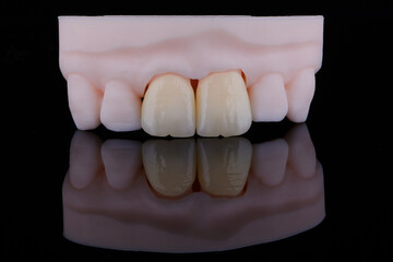 High-quality naturally dental single crowns made of zirconium for fixation to the frontal teeth of upper jaw. © gorynvd