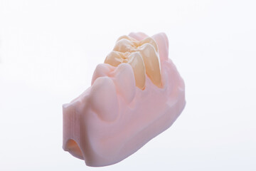 High-quality naturally dental single crowns made of zirconium for fixation to the teeth of upper jaw. © gorynvd