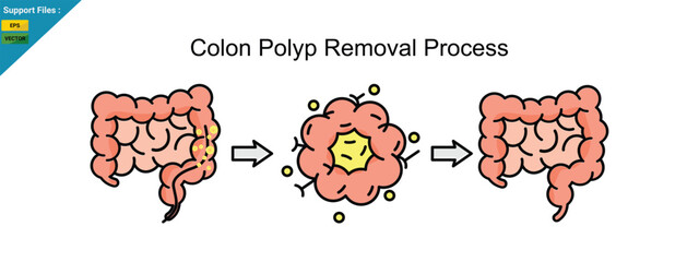 Colon Polyp Removal Process, vector illustration, icon color line.