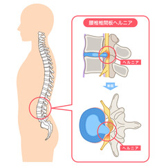 腰椎椎間板ヘルニア　椎間板の構造　腰痛
