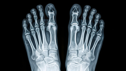 Naklejka premium Xray image showing human feet and toe bone structure