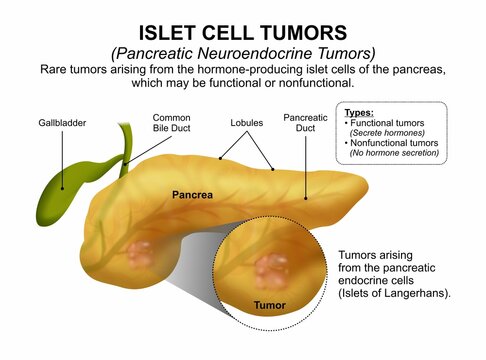 Islet Cell Tumors (Pancreatic Neuroendocrine Tumors)