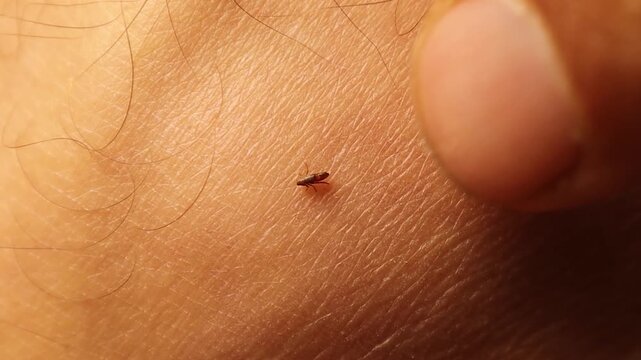 Close-up flea on human skin jumping away from a finger after animal to human transfer. Highlights zoonotic risk and occupational exposure, For medical, veterinary, health education and documentary use