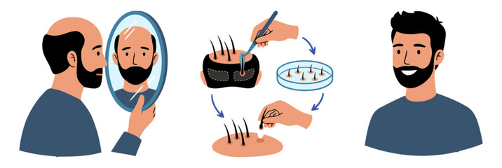 Hair transplant surgery procedure concept with before and after results. Vector illustration of bald man looking in mirror and final successful hair restoration treatment.