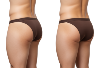 Rear view of man's lower back, buttocks, upper thighs in dark thong; left cellulite, right smooth, red line separates on transparent background, cosmetic result concept