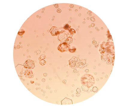 Cystine crystal in urine, type of kidney stone made from cystine chemical, rare disorder called cystinuria.