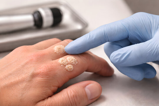 Photorealistic 3D depiction of common warts on the hand, close-up of knuckles and fingers showing several small rough hyperkeratotic papules with a slightly raised cauliflower-like surface