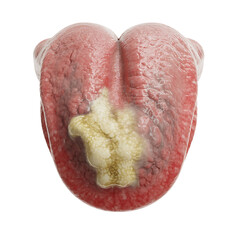 Human Tongue with Large White Patch lesion with Transparent Background