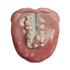 Human tongue with thick white coating and red spots with Transparent Background