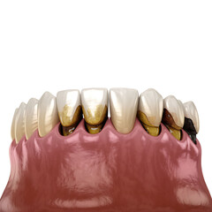 Human teeth with severe plaque and decay dental on a Transparent Background