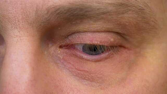 Close up of a bloodshot eye damage by an injury. Hemorrhage of the eye, rupture of a vessel in the eye, blood in the eye