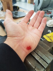 A wound on a worker's hand in a workshop