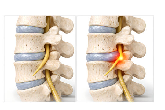 Photorealistic 3D medical illustration of herniated disc with nerve compression, sagittal view of lumbar spine showing bulging intervertebral disc pressing on adjacent spinal nerve root