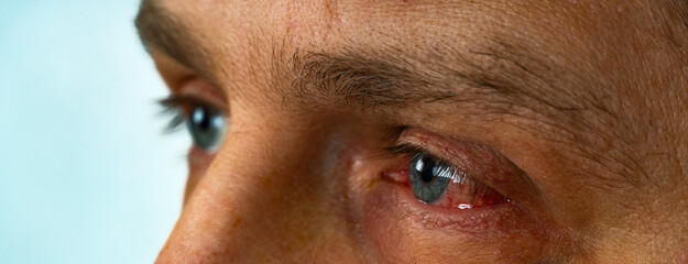 Close up of a bloodshot eye damage by an injury, selective focus. Hemorrhage of the eye, rupture of a vessel in the eye, blood in the eye