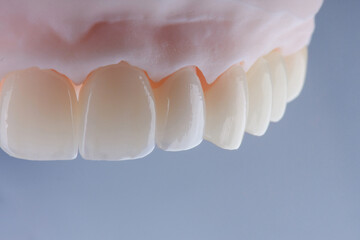 High-quality dental crowns made of zirconium for fixation to the teeth of upper jaw. © gorynvd