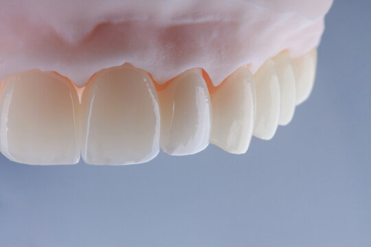 High-quality dental crowns made of zirconium for fixation to the teeth of upper jaw.