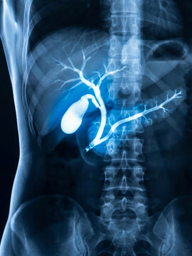 Digital ERCP / MRCP Imaging: Fluoroscopic Visualization of Biliary Tree, Gallbladder, and Pancreatic Duct inside Human Torso
