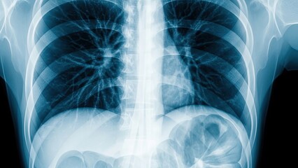 x ray of a chest