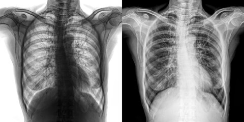 Chest Pa View X-Ray Radiograph Showing Lung Fields and Thoracic Anatomy for Early Detection and Diagnosis of Pulmonary Anthrax Isolated on Transparent Background