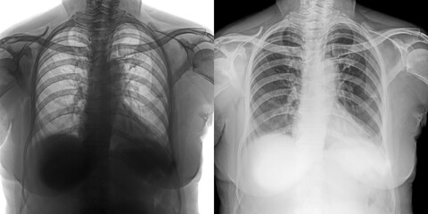 Chest Pa Projection Diagnostic X-Ray Radiograph Showing Lung Fields and Pathological Findings for Detection of Pulmonary Anthrax Isolated on Transparent Background