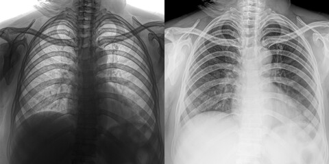 Chest Pa View X-Ray Image Displaying Pulmonary Anatomy and Lung Opacities for Evaluation of Pulmonary Anthrax Isolated on Transparent Background