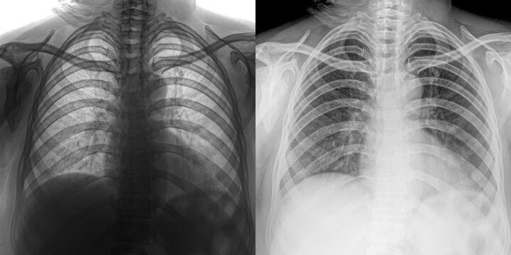 Chest Pa View X-Ray Image Displaying Pulmonary Anatomy and Lung Opacities for Evaluation of Pulmonary Anthrax Isolated on Transparent Background
