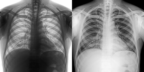 Chest Posteroanterior Projection X-Ray Radiograph Illustrating Pulmonary Changes for Diagnosis of Anthrax-Related Lung Infection Isolated on Transparent Background