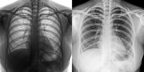 Chest Pa View X-Ray Showing Pulmonary Structure and Abnormal Patterns for Detection of Pulmonary Anthrax Isolated on Transparent Background