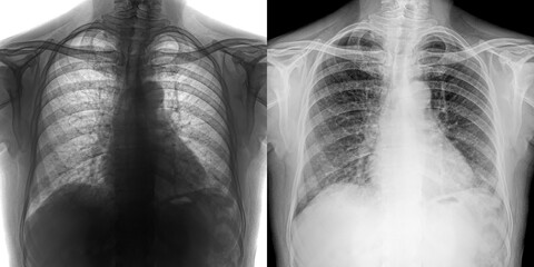 Chest Posteroanterior View X-Ray Showing Clear Lung Visualization for Diagnosis and Study of Pulmonary Anthrax Isolated on Transparent Background