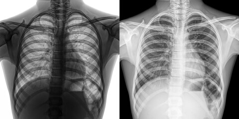 Chest Posteroanterior X-Ray Radiograph Depicting Pulmonary Structure and Diagnostic Features of Anthrax Infection Isolated on Transparent Background